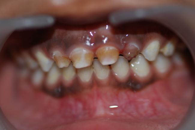 Patient ( Male, 3 years 10 months) came with a complaint of decayed front teeth.