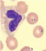 Microscopic Diagnosis Blood smear stained with Giemsa, showing a white blood cell (on left side) and several red blood cells, two of which are infected with Plasmodium falciparum (on right side).
