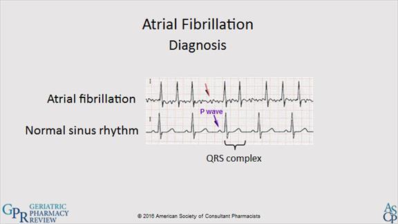 1.14 Atrial Fibrillation AF is an irregular-irregular heart rhythm, in that both the rate and rhythm are out of sync.