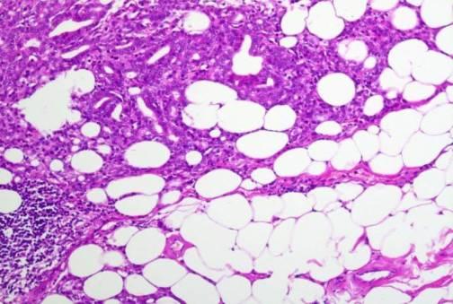 EPE The presence of neoplastic glands abutting on or within periprostatic fat or beyond the