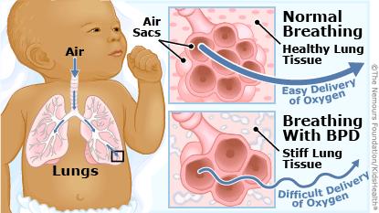 Bronchopulmonary dysplasia More common in premature infants Inflammation and scarring of