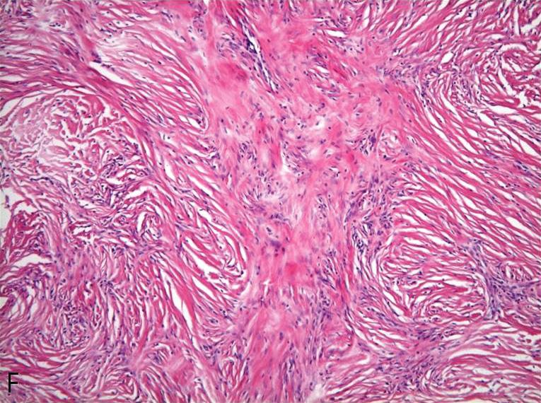 (A) The fibrocollagenous type shows a predominance of collagen and fibroblasts in a