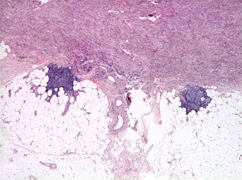 A Clinical & Histopathological Study of of DF Fig. 8. Histopathologic features of dermatofibroma.