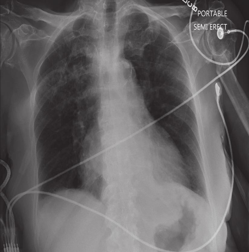 (a) (b) (c) Figure 2: Chest CT with contrast ((a) and (b)): lung window (a) showing right upper lobe 15 mm lung nodule (red arrow), pulmonary congestion, and