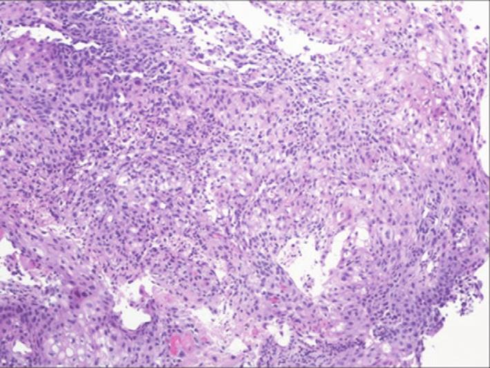 The EB of right upper lobe endobronchial lesion andthecorebiopsyofmaterialaspiratedfrom4rlymphnode were consistent with squamous cell carcinoma (Figure 4).