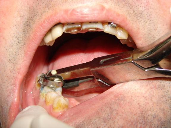 tooth can also result in the band bending or splitting which can make the band more difficult to remove.
