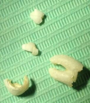 Case 1 The patient reported to the surgical unit with continuous pain and recurrent swelling clinically diagnosed as chronic pericoronitis and wished to have the left lower third molar removed.