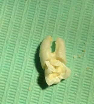 The tooth was removed in multiple pieces in this patient to avoid unnecessary involvement of vital structures such as soft tissue exposure and excessive bone cutting.