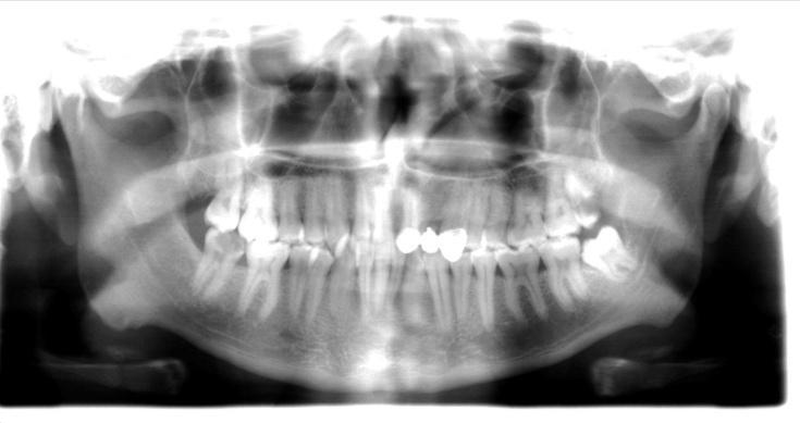 He had bad breath (halitosis) and slight mobility of the adjacent second molar due to lack of bone support (Figure 3).