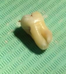 Some part of the tooth structure and the roots get blocked by the bony mass of the mandible allowing only the