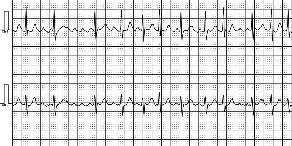 Atrial Flutter with Variable