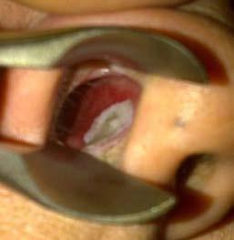 Control Anterior Epistaxis Apply direct manual pressure for at least 10