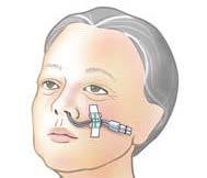 Swelling in the nasal anatomy will reduce and the balloons