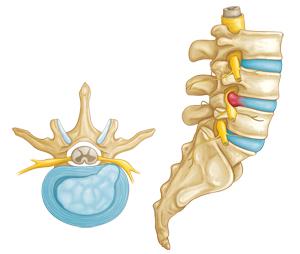 This pressure against the outer ring may cause lower back pain. A herniated disk (side view and cross-section).