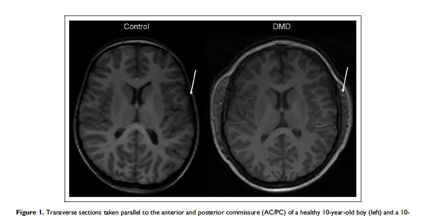Transverse sections taken parallel to the anterior and posterior commissure (AC/PC) of a healthy 10-year-old boy (left) and a 10- year-old boy with Duchenne