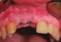 impressions and handmade acrylic provisional crowns on temporary