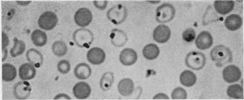 results of 1 comparative observations were almost identical,.6% of siderocytes compared with.9% of cells containing Pappenheimer bodies.