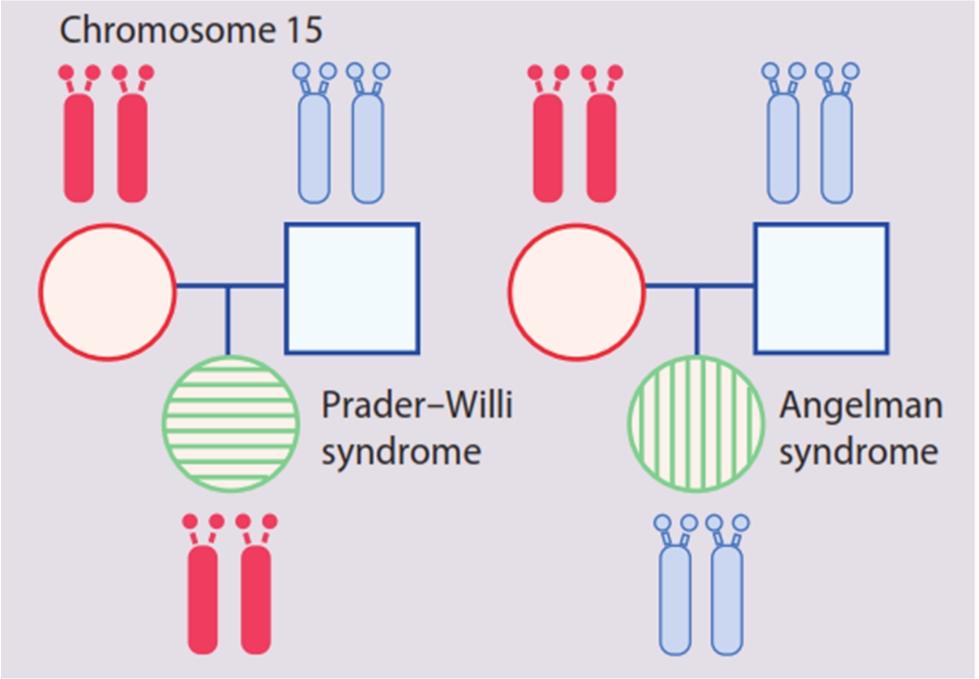Prader-Willi syndrome is caused by loss from the paternal chromosome of an imprinted locus mapping to 15q11-13, Angelman syndrome, is