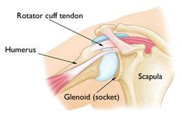 Reverse Total Shoulder Replacement Every year, thousands of conventional total shoulder replacements are successfully done in the United States for patients with shoulder arthritis.
