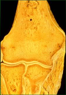 brachialis (and on ulnar tuberosity) Medial