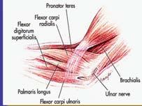 Coronoid Common flexor tendon Flexor carpi radialis Median nerve Palmaris