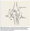Compression stress laterally Radial head and capitellum Deceleration Phase Ball Release thru maximum IR of shoulder Elbow
