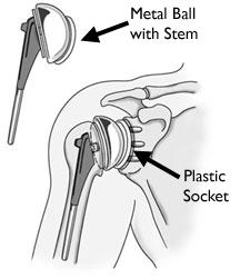 A total shoulder joint replacement. These components come in various sizes. They may be either cemented or "press fit" into the bone.