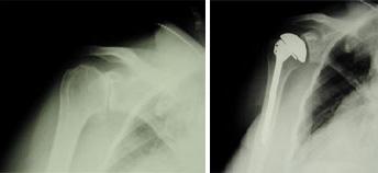 These x-rays were taken before and after total shoulder replacement surgery for osteoarthritis.