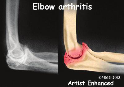 Osteoarthritis of the elbow isn't like OA of the hip or knee. Most of the time, the articular cartilage isn't damaged. The joint space remains close to normal.