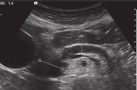 326 Melania Ardelean et al Contrast Enhanced Ultrasound in the pathology of the pancreas a monocentric experience specific perfusion.