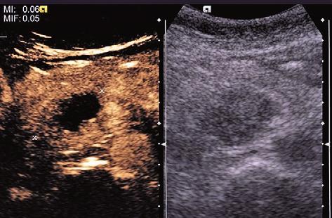 acute severe pancreatitis with/without necrosis (we established the severity index according to Atlanta criteria) (fig 3); Group 3 other pathologies (fig 4).