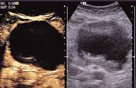 late phases. The contrast vascular patterns were defined by comparing the enhancement behavior of the pancreatic lesion to the surrounding pancreatic parenchyma.