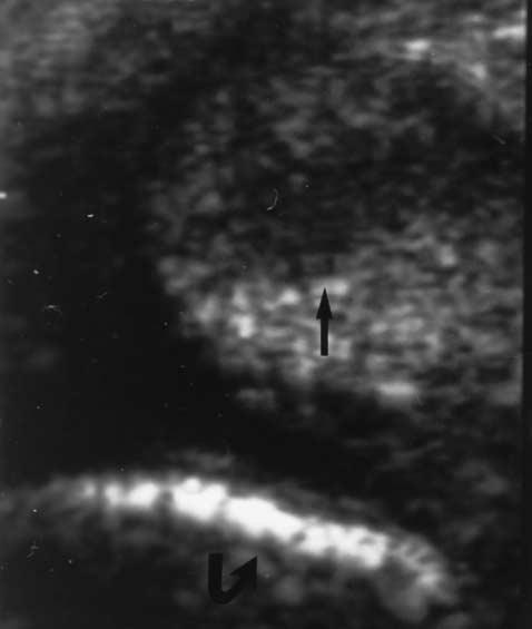 J Ultrasound Med 17:249 256, 1998 WAITCHES ET AL 251 A Four tendons that were thought to be torn sonographically were found to be normal at surgery.