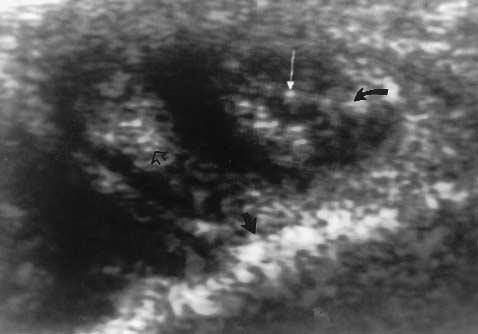 252 ANKLE TENDON TEARS J Ultrasound Med 17:249 256, 1998 Figure 2 Transverse images of the PB (short open black arrow) and PL (curved black arrow) tendons just below the level of the malleolus.