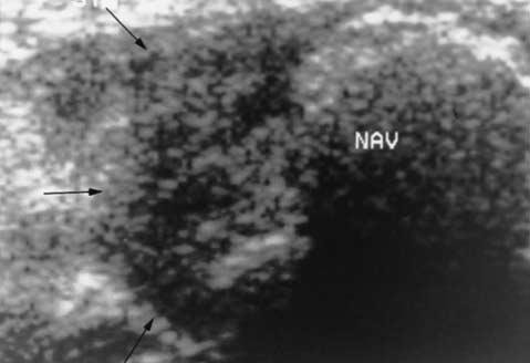Further sonographic and clinical follow-up may be necessary in patients with inconsistent surgical-sonographic correlation and persistent symptoms.