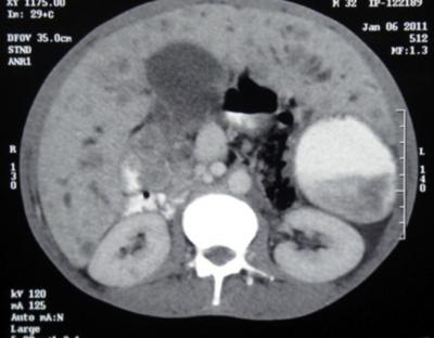 Note is also made of interruption of the hepatic segment of IVC in the same patient