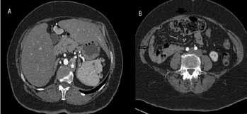 (A) There is a midline liver, a left sided stomach and lobulated spleen with multiple accessory spleens (black stars), a midline gallbladder (thin white arrow) and an anteriorly positioned portal