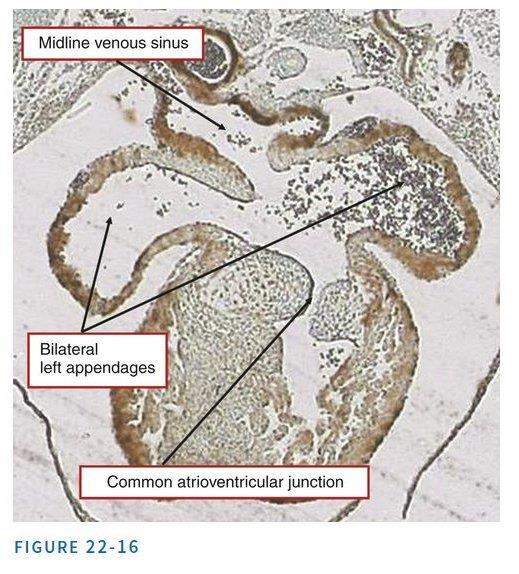 Atrial appendages in left atrial isomerism Usual atrial arrangement in a human fetal HREM specimen at 12+5 weeks Bilateral left atrial appendages in a mouse model Liat Gindes, Hikoro Matsui, Reuven
