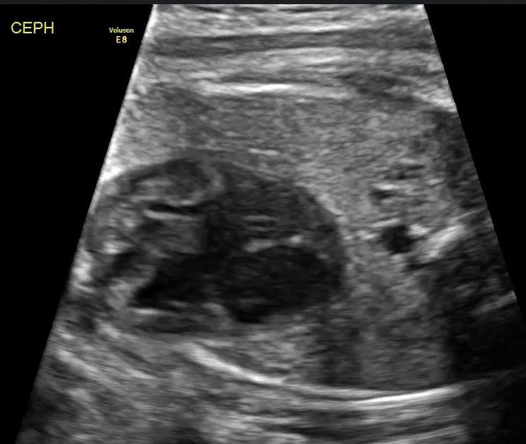 Bilateral right atrial appendages Usual atrial arrangement in a human fetal HREM specimen at 12+5 weeks Liat Gindes,