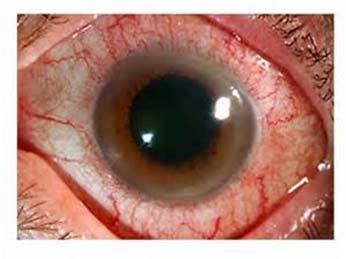 Retrobulbar Neuritis EMB is stopped Patient referred to opthalmologist EMB not restarted unless another cause of the neuritis or vision problem definitely identified Rare cases of optic neuritis have