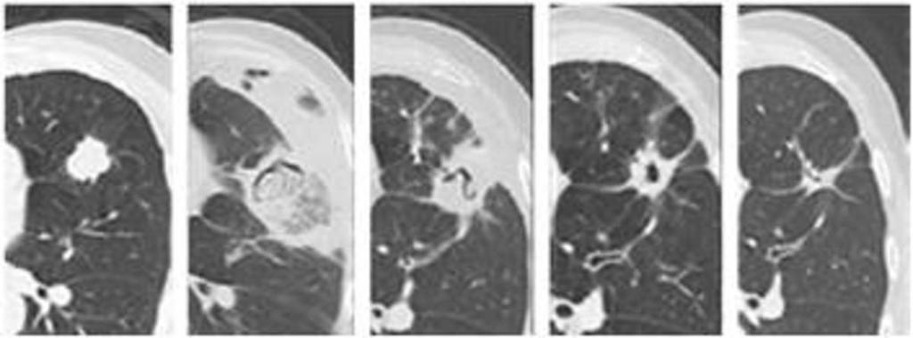 Fig. 2: Tumour response to RFA during