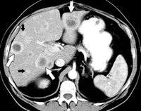 Nearly 50% of patients with GIST will present with spread or metastasis. Most involve the liver and peritoneum.