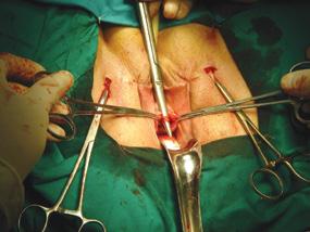 Fig. 3. Final intraoperative aspect of suburethral prosthesis in TOT technique Fig. 4.