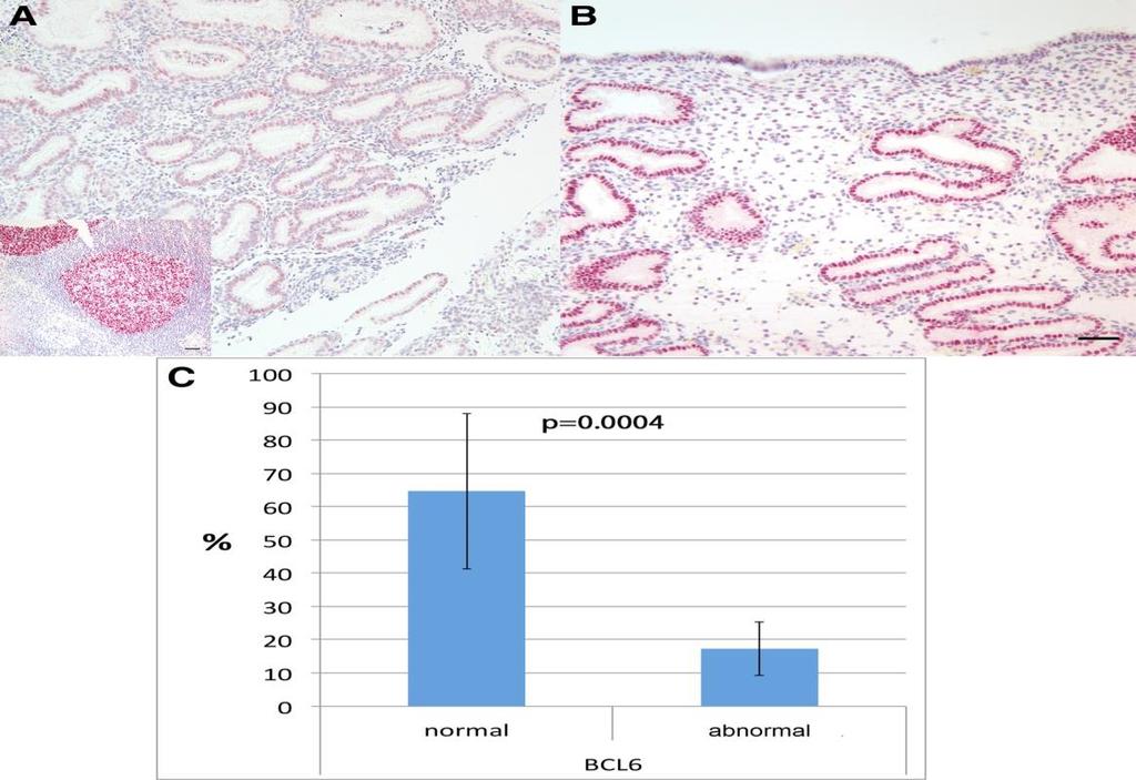 Receptiva Assay Endometrial Biopsy in luteal phase Detects: - BCL-6: Chronic inflammation due to endometriosis/hydrosalpiges - CD138: Chronic endometritis Recommended for women with unexplained