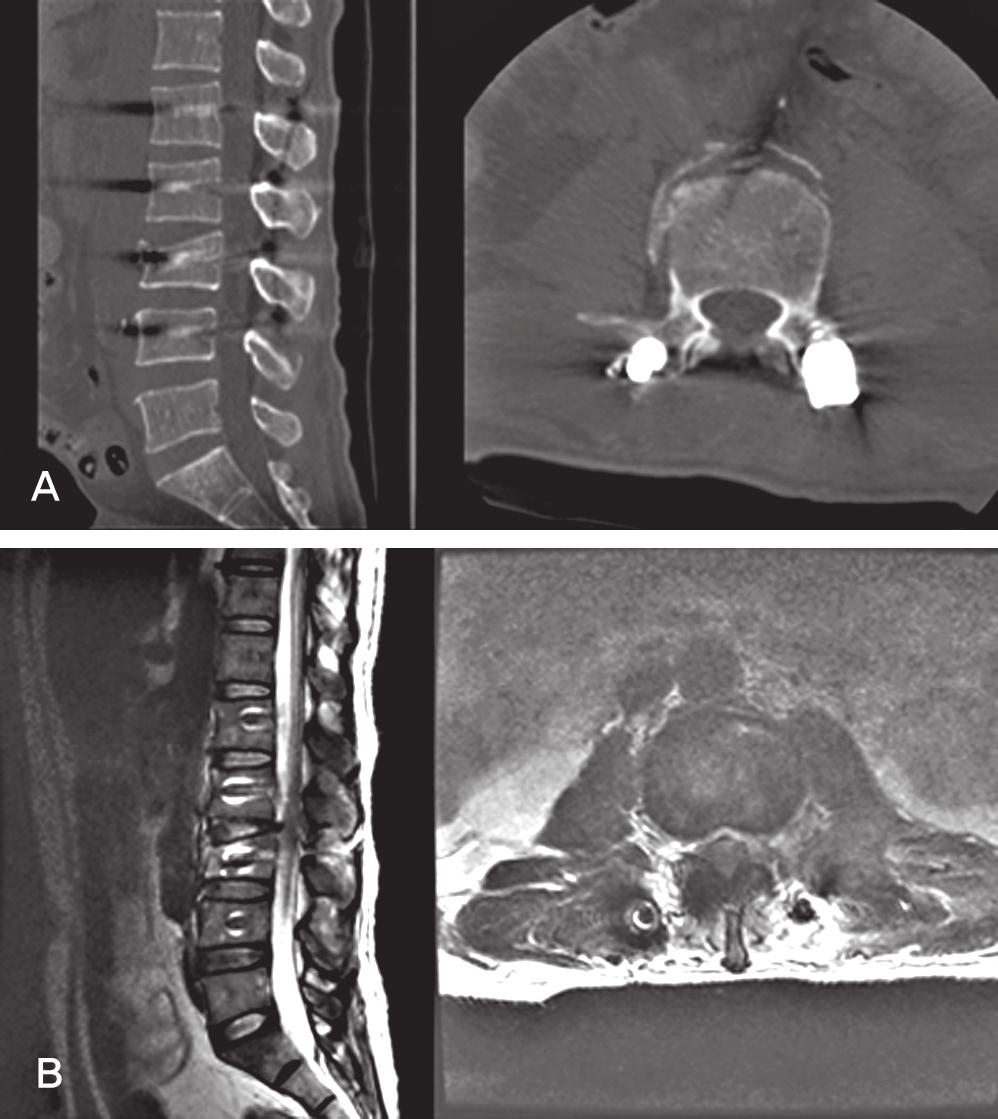 spinal surgery. It had an operation time of 58 min and a blood loss of 150cc (Fig.2).