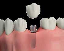 TRADITIONAL SOLUTIONS FOR MISSING TEETH Previously the most common