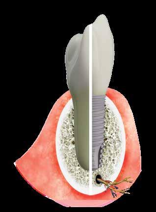 A successful implantation can resolve almost all problems associated with tooth loss: Once the implant and prosthesis is in place it hinders the