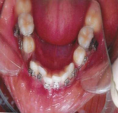 2.2 Exclusion criteria Subjects with following criteria were not included in the study, Congenitally missing permanent teeth, Systemic disease condition, History of previous orthodontic treatment or