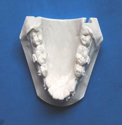 The bonding of 0.022 MBT brackets (Mini Master brackets, American orthodontics.) was done using light cure adhesive paste and primer (Transbond 3M Unitek).