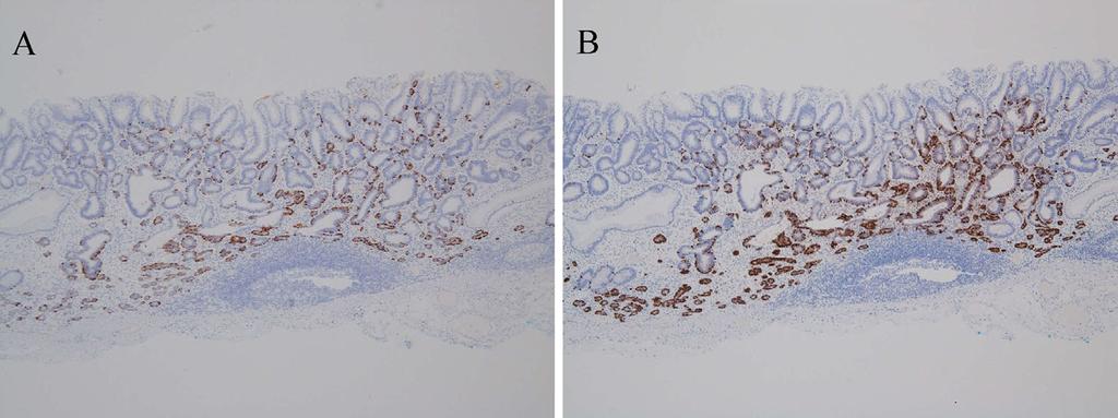 Both tumors were similarly composed of small tubular structures, but the tumor cells of the NET were characterized by smaller tubules with eosinophilic granular cytoplasm distributed in the lower